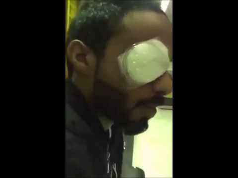 مواطن يفقد احدى عينيه بسبب مزاح مع صديقه بجهاز الليزر الحارق