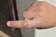 مدني حائل …. يخرج قطعة حديدية عالقة بأحد أصابع طفل .