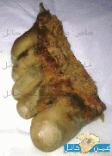 جنزير دباب يقطع الأصابع الخمس لقدم طفلة ذات الخمس سنوات # (بالصور)  شمال مدينة حائل بالنفود