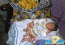 ولادة طفل باكستاني بـ 6 أرجل