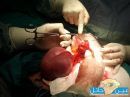 إستخراج ( لولب ) من رحم فتاة حملت به #بمستشفى مدينة السليمي