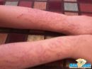 يتسبب بحرق وتشوية يدي طفلة 8 اعوام والجهات الرقابية في سبات #مشغل نسائي بسوق برزان بحائل