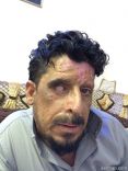 عامر .. أحرق جسمه ( الأسيد ) وفقد عينه .. يُنَاشِد أهل الخير لمُساعدته
