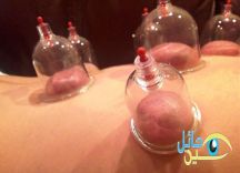 وزارة الصحة توافق على الترخيص لممارسة الحجامة