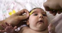 “زيكا” يتسبب في إتلاف مخ الأجنة