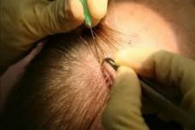 ​إحصائية: 30 ألف سعودي سافروا إلى تركيا لزراعة الشعر خلال عام