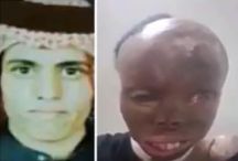 بعد تعرضه لحروق خطيرة.. محمد بن سلمان يتكفل بعلاج الحربي في أمريكا